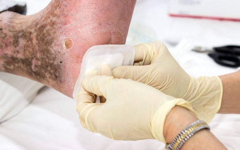 بهبود زخم پای دیابتی