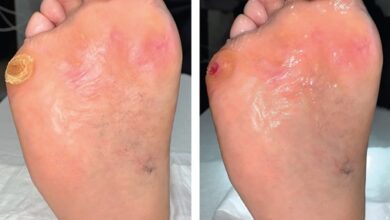 کلینیک امیدنو گامی نو به سوی درمان زخم پای دیابتی