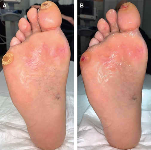 درمان زخم پای دیابتی