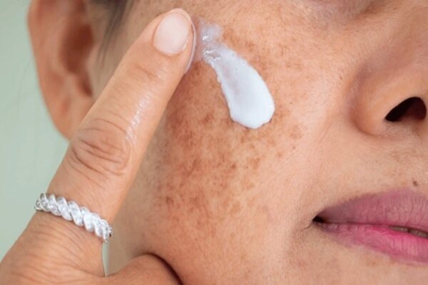 هشدار؛ مراقب سوختگیهای پنهان آفتاب باشید هشدار؛ مراقب سوختگیهای پنهان آفتاب باشید