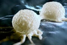 افزایش دقت ماموگرافی و کاهش تشخیص دیرهنگام سرطان پستان با هوش مصنوعی