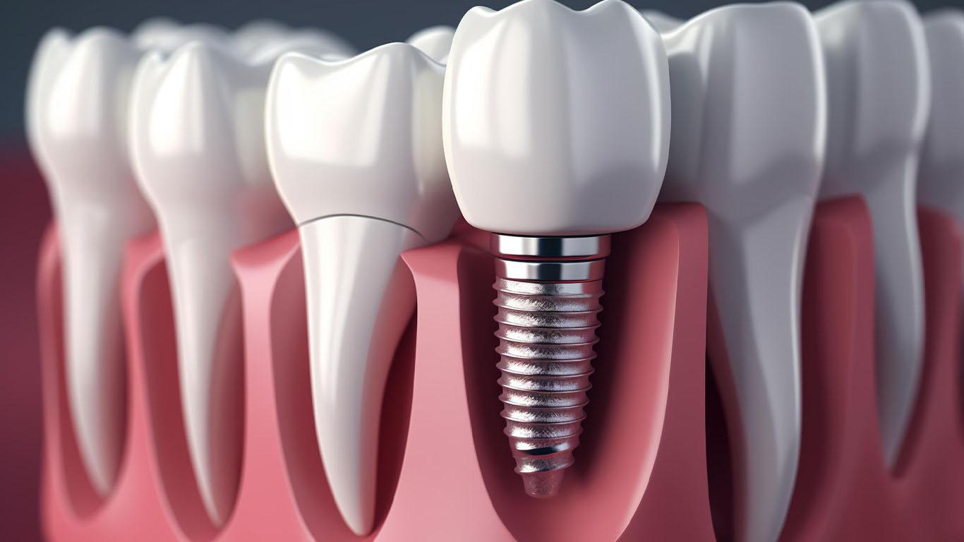 مقایسه ایمپلنت دندان با بریج و پروتز: کدام گزینه مناسب شماست؟