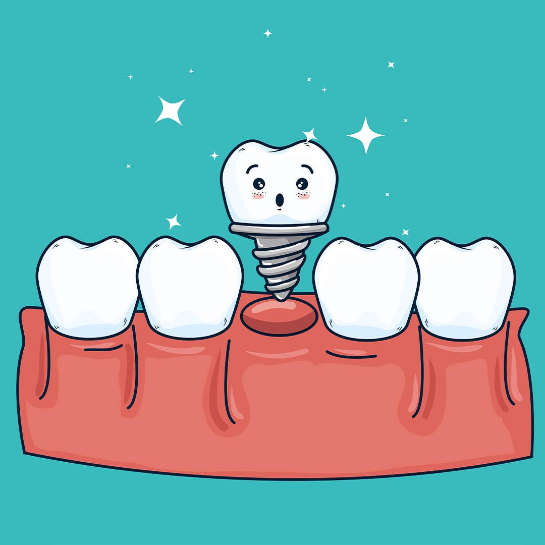 مقایسه ایمپلنت دندان با بریج و پروتز: کدام گزینه مناسب شماست؟