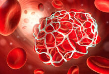 هشدار درباره خطر ماساژ پا برای بیماران مبتلا به لخته خون