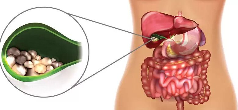 سنگ کیسه صفرا چیست و چگونه درمان میشود؟ راهنمای کامل تشخیص، علائم و درمان سنگ کیسه صفرا چیست و چگونه درمان میشود