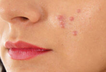 از ارتباط بین آکنه‌های پوستی با قند و شکر چه می‌دانید؟