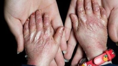 افزودن ۲۵ بیماری جدید به فهرست بیماریهای نادر