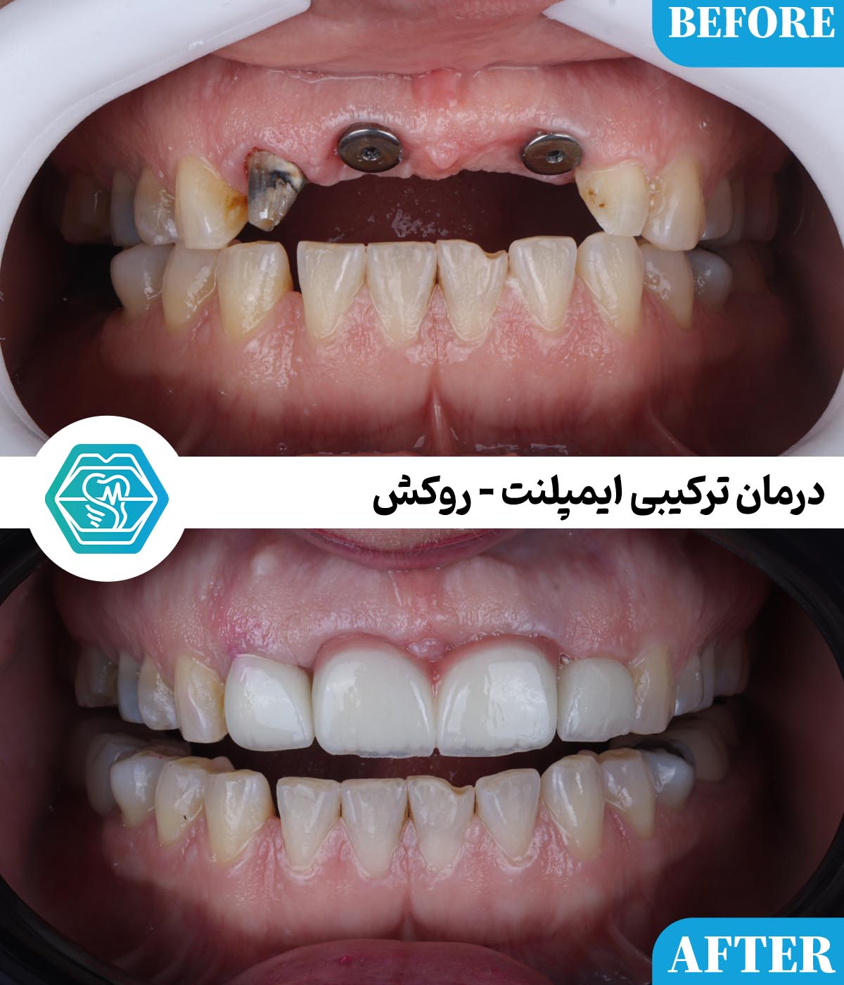 چرا اختلاف قیمت ایمپلنت دندان در شیراز زیاد است؟ راهنمای تشخیص قیمت واقعی از قیمت‌های تبلیغاتی