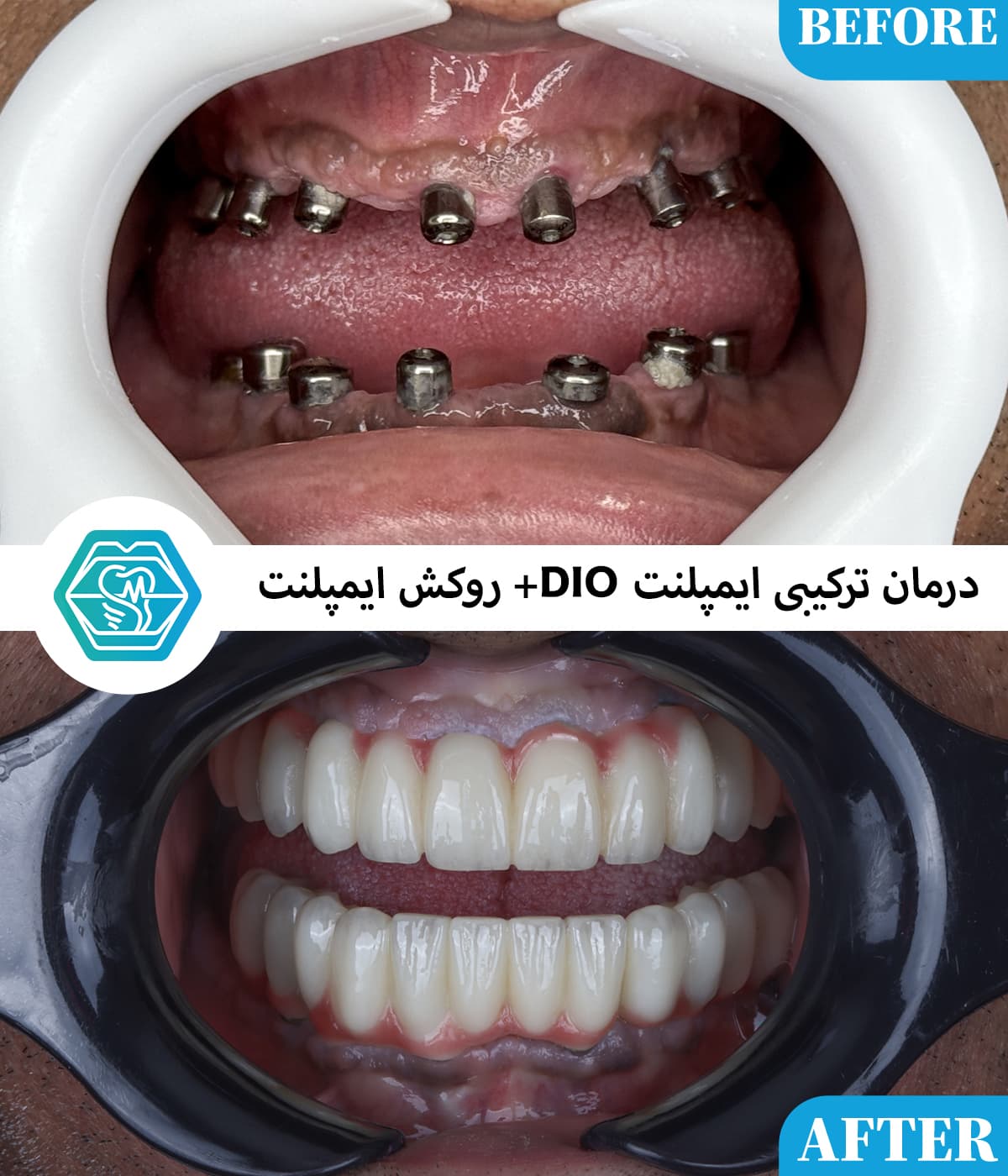 چرا اختلاف قیمت ایمپلنت دندان در شیراز زیاد است؟ راهنمای تشخیص قیمت واقعی از قیمت‌های تبلیغاتی