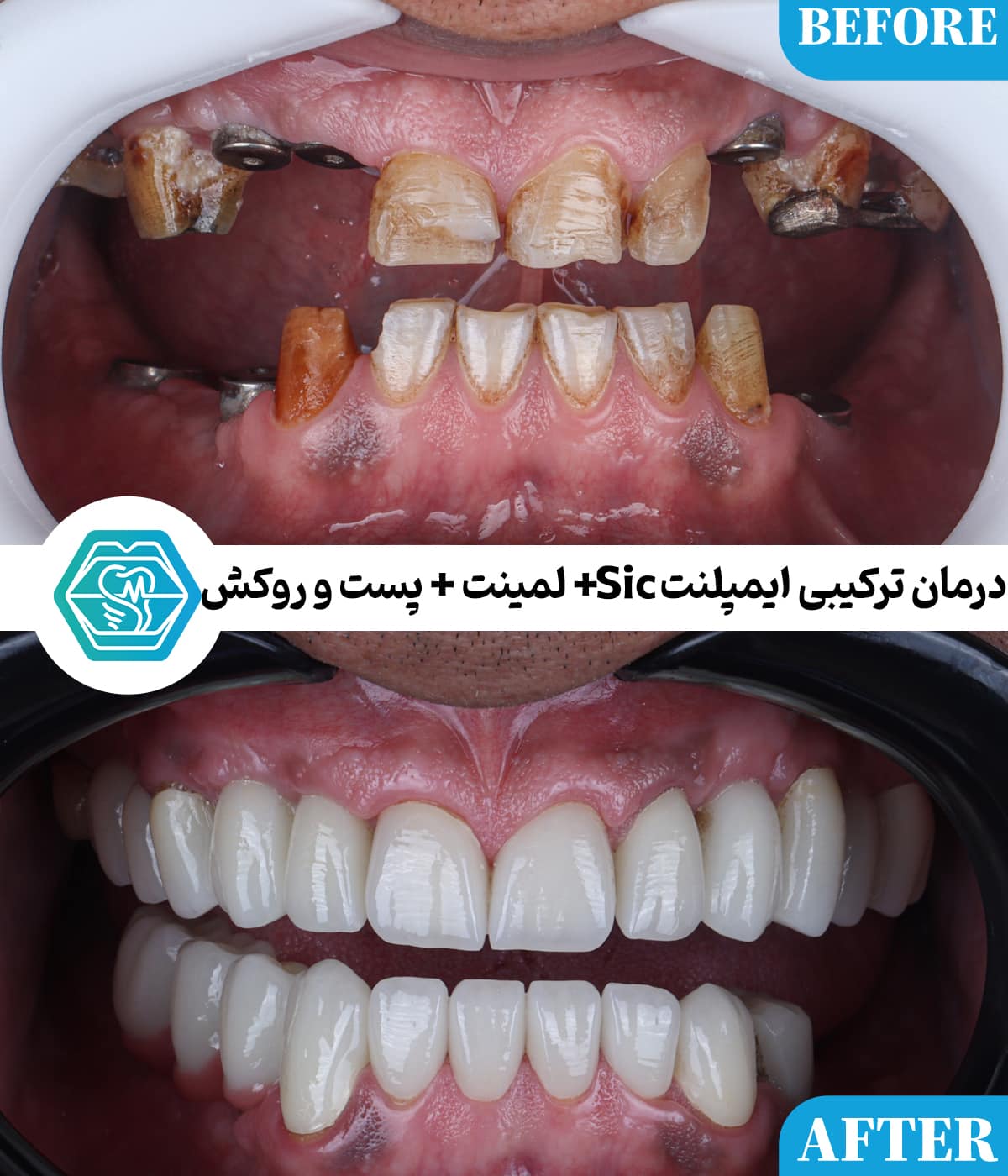 چرا اختلاف قیمت ایمپلنت دندان در شیراز زیاد است؟ راهنمای تشخیص قیمت واقعی از قیمت‌های تبلیغاتی