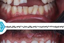 چرا اختلاف قیمت ایمپلنت دندان در شیراز زیاد است؟ راهنمای تشخیص قیمت واقعی از قیمت‌های تبلیغاتی