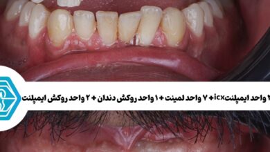چرا اختلاف قیمت ایمپلنت دندان در شیراز زیاد است؟ راهنمای تشخیص قیمت واقعی از قیمت‌های تبلیغاتی