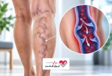 واریس را نادیده نگیرید | این رگ‌های برجسته فقط یک مشکل ظاهری نیستند