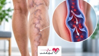 واریس را نادیده نگیرید | این رگ‌های برجسته فقط یک مشکل ظاهری نیستند